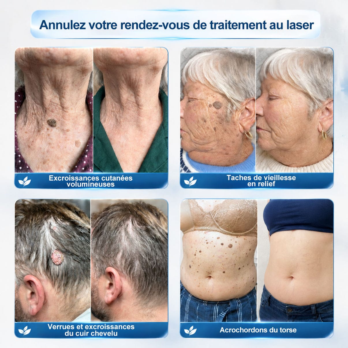 Roller Picdo® - 7 Jours pour une peau plus nette • Efface taches & excroissances sans cicatrice