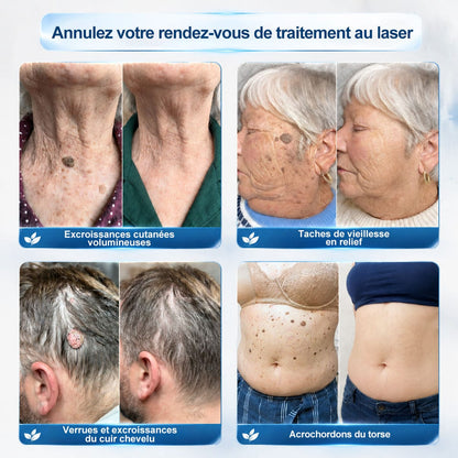 Roller Picdo® - 7 Jours pour une peau plus nette • Efface taches & excroissances sans cicatrice