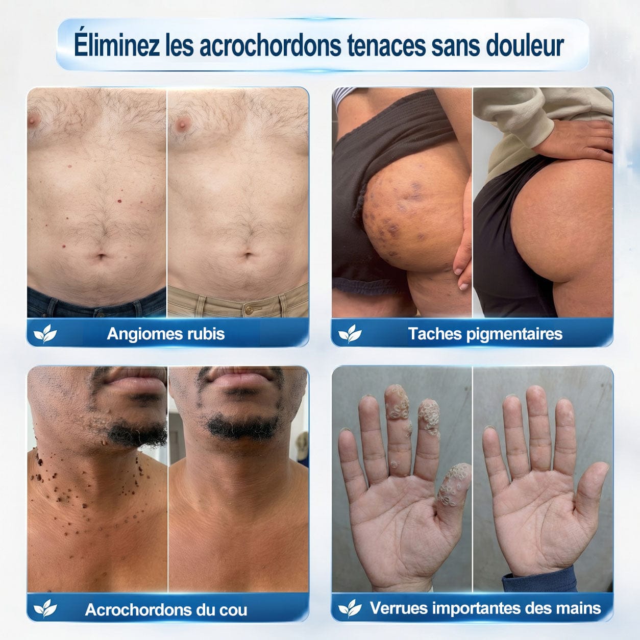 Roller Picdo® - 7 Jours pour une peau plus nette • Efface taches & excroissances sans cicatrice