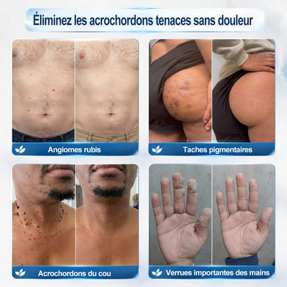 Roller Picdo® - 7 Jours pour une peau plus nette • Efface taches & excroissances sans cicatrice