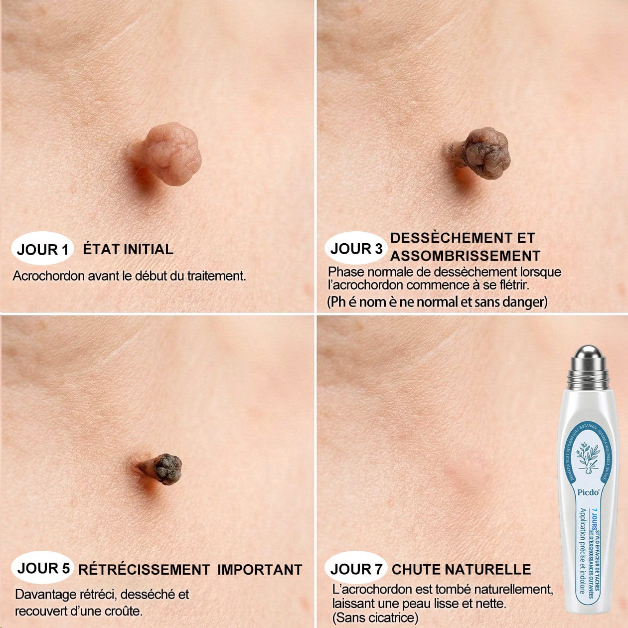 Roller Picdo® - 7 Jours pour une peau plus nette • Efface taches & excroissances sans cicatrice
