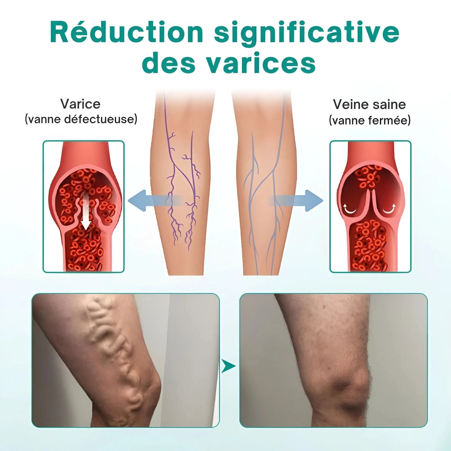 Patch Anti-Varices | Dites adieu aux douleurs et varices en 14 jours